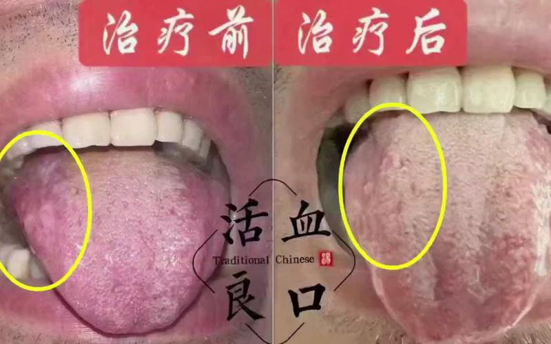 口腔扁平苔藓那家专业,口腔扁平苔藓哪家医院专治?-第4张图片-职教招生网 口腔扁平苔藓那家专业,口腔扁平苔藓哪家医院专治?-第4张图片-职教招生网